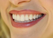 Tìm hiểu quy trình làm răng toàn sứ